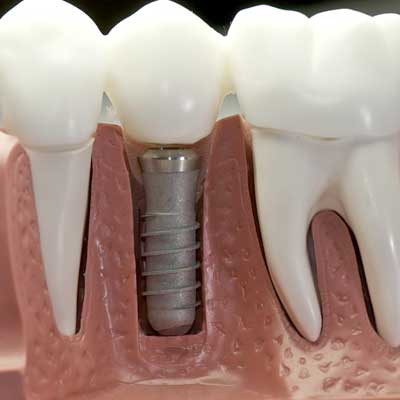 mdk service-dental-implant